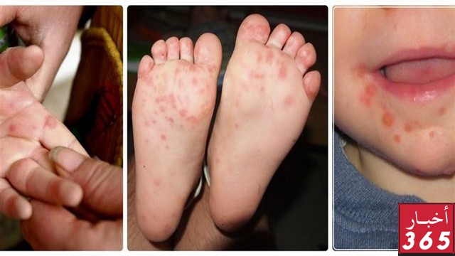 ظهور فيروس HFMD